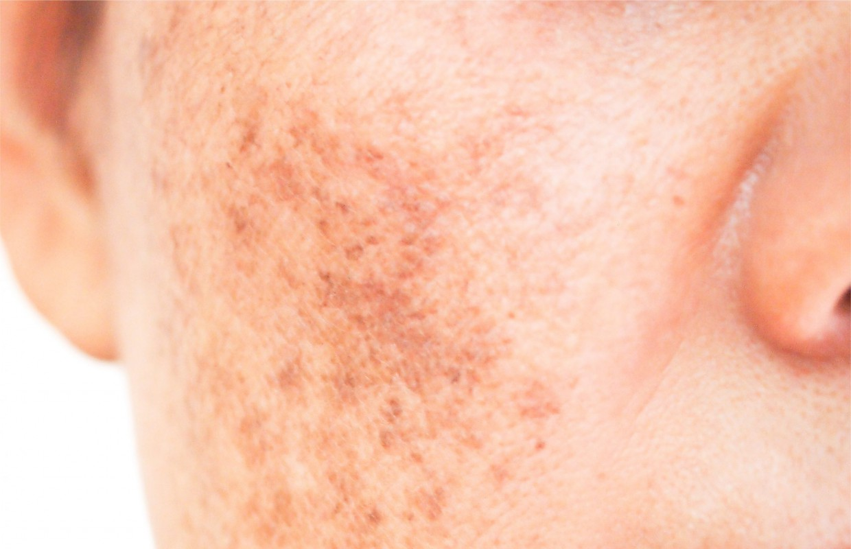 How to Get Rid of Sun Spots From Summer in 7 Steps